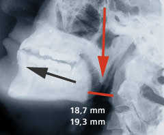 Mit Snorban® : Röntgenaufnahmen zeigen erweiterte Atemwege bei der Anwendung von Snorban®, markiert mit einem roten Strich.