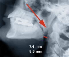 Ohne Snorban® : Röntgenaufnahmen zeigen die Atemwege. Der Raum für die Luftpassage ist mit einem roten Strich markiert.